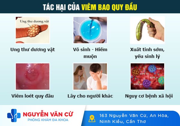 Phương Pháp Điều Trị Viêm Bao Quy Đầu An Toàn – Hiệu Quả Cao