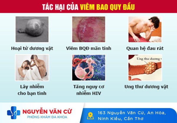 Hình ảnh viêm bao quy đầu. Viêm bao quy đầu có nguy hiểm không?