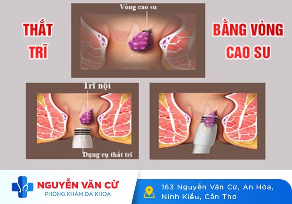 Thắt Búi Trĩ Có Thực Sự An Toàn Và Hiệu Qủa