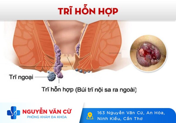 Một số hình ảnh bệnh trĩ các cấp độ