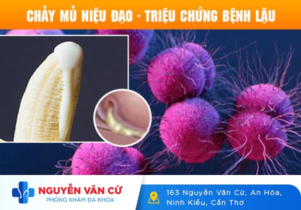 Lỗ sáo chảy mủ là bị bệnh gì? Có nguy hiểm không?