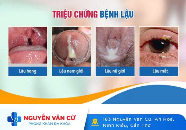 Vùng kín chảy mủ – coi chừng mắc bệnh lậu