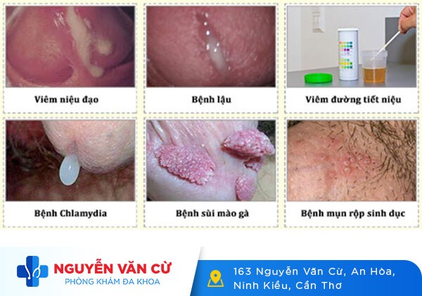 4 nguyên nhân khiến cậu nhỏ chảy mủ bạn cần biết