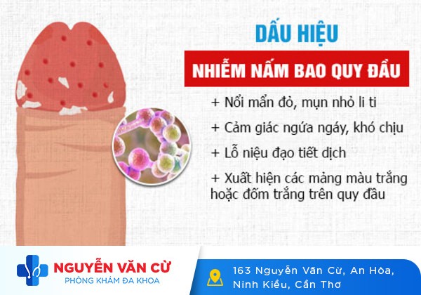 Nấm bao quy đầu – khốn khổ vì ngứa rát mọi nơi mọi lúc