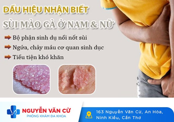 Cách nhận biết sùi mào gà sớm nhất