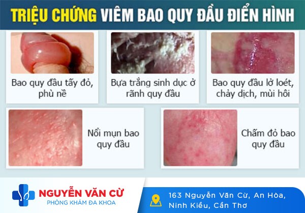 Bệnh Dương Vật Là Gì? Cách Chữa Trị Hiệu Quả Hiện Nay