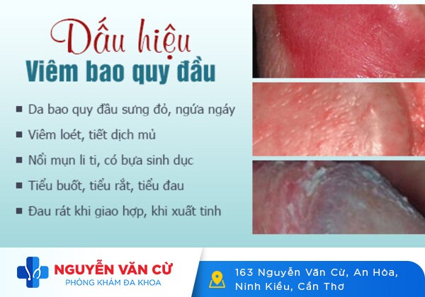 Chảy máu bao quy đầu và những điều cần lưu ý