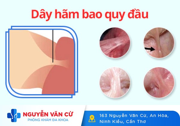 Dây hãm bao quy đầu bị đau và cách xử lý