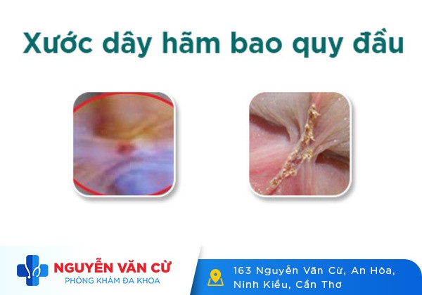 Bị Đứt Dây Hãm Bao Quy Đầu