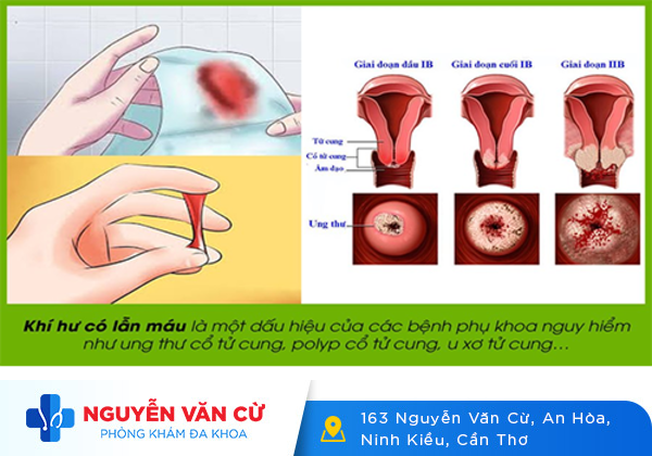Chảy Máu Âm Đạo – Nguyên Nhân Và Cách Hỗ Trợ Điều Trị