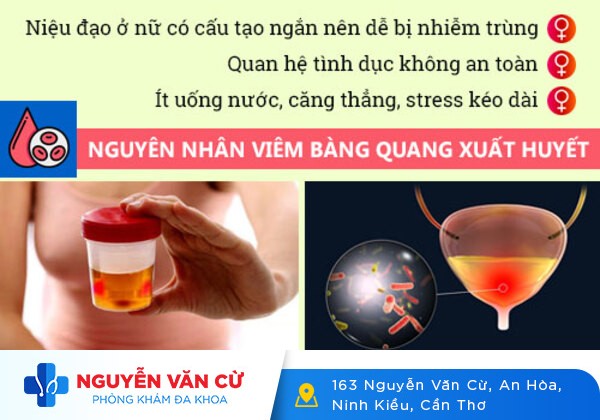 Viêm bàng quang và cách hỗ trợ điều trị hiệu quả