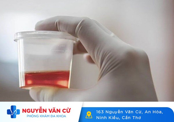 Chi Phí Chữa Tiểu Buốt, Tiểu Ra Máu Hiệu Quả