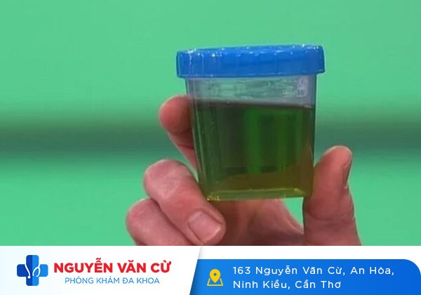 Nước tiểu có màu lạ – dấu hiệu của nhiều bệnh lý nguy hiểm